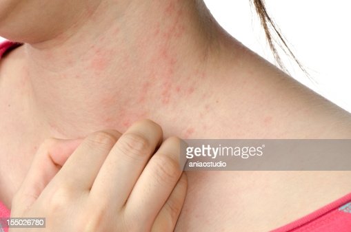 Eczema Skin On Neck High
