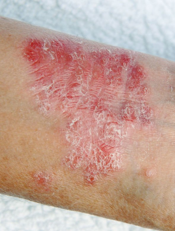 Eczema: Skin treatment
