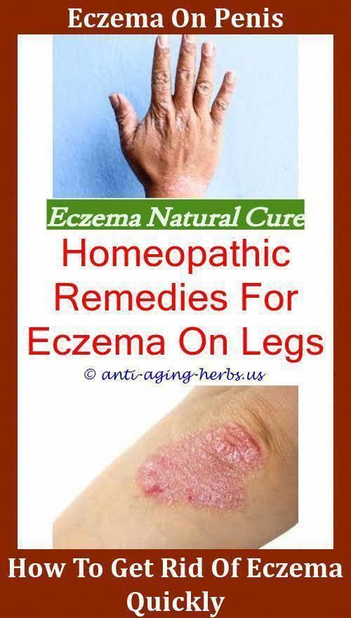 Eczema Solutions The Eczema Diet Amazon Is Eczema ...