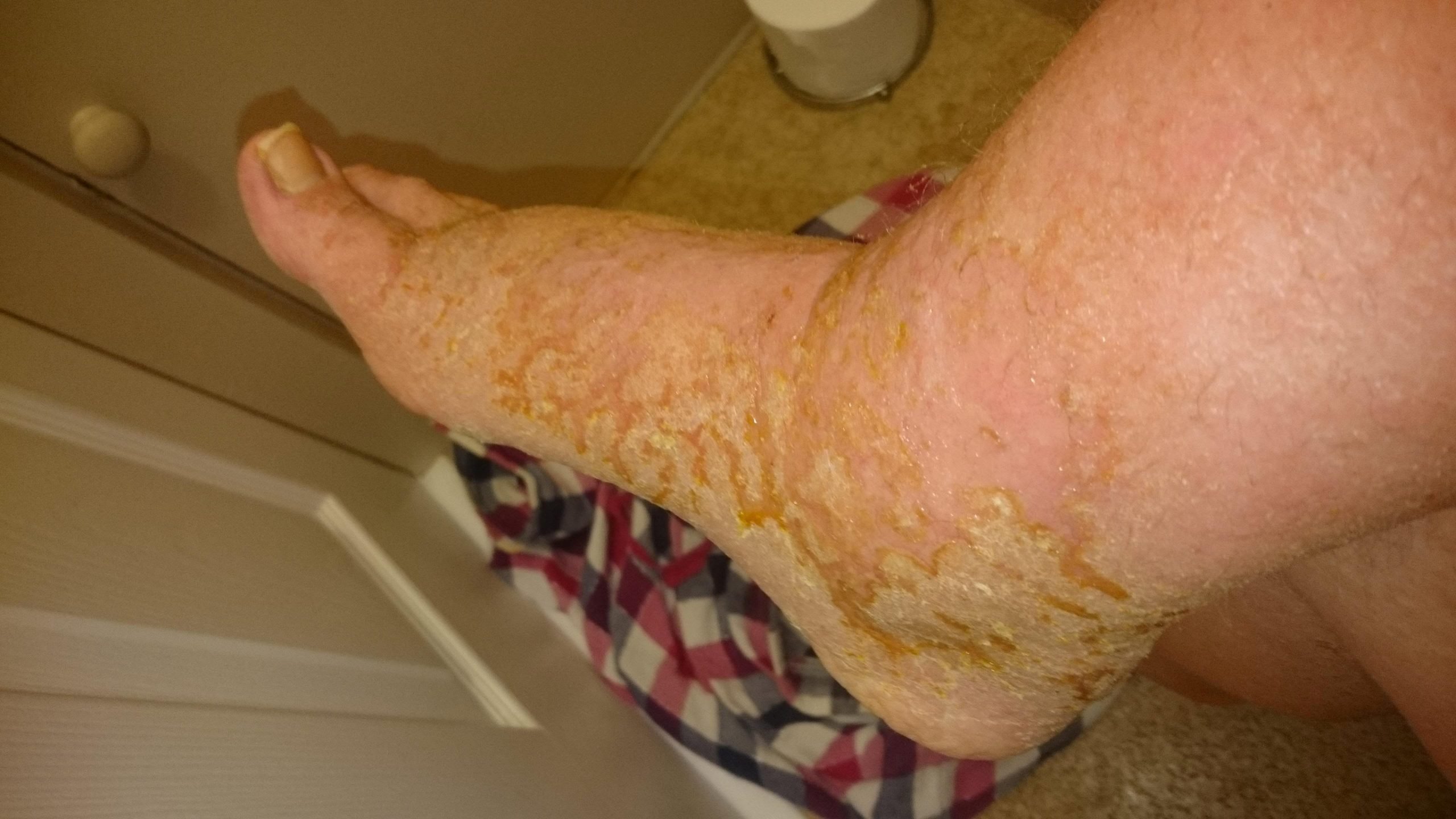 Eczema sufferer, 23, spent 18 years using cream prescribed ...