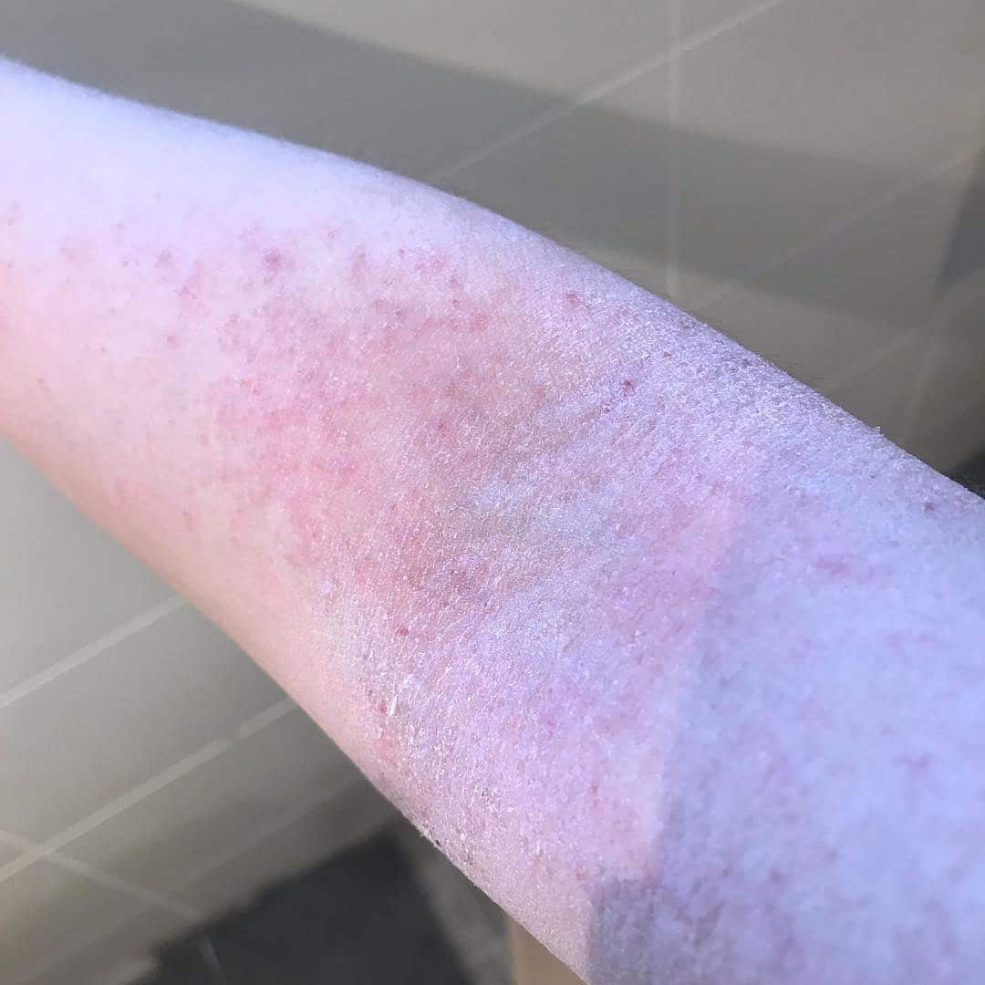 Eczema sufferer whos been battling itchy, flaky skin since ditching ...