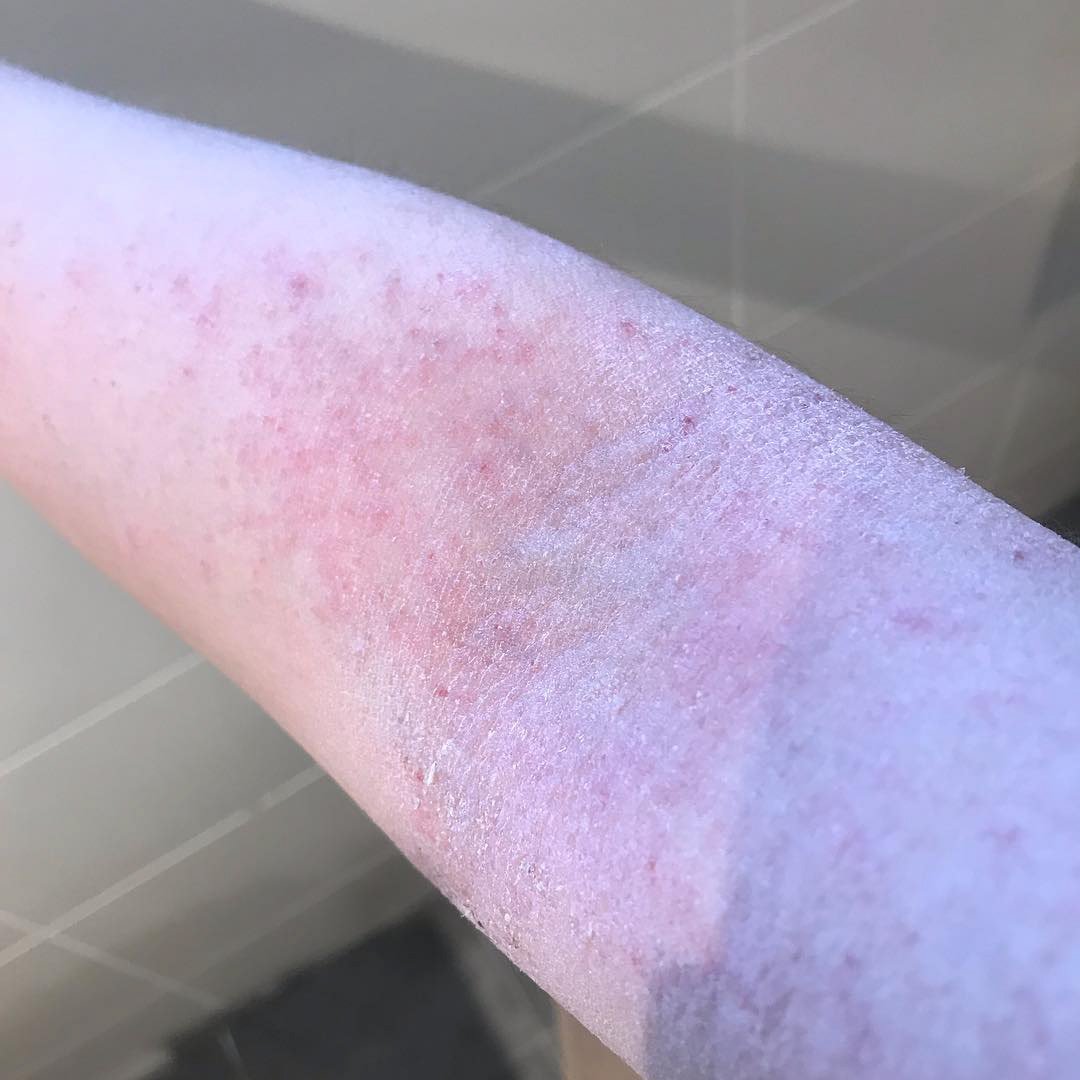 Eczema sufferer whos been battling itchy, flaky skin ...