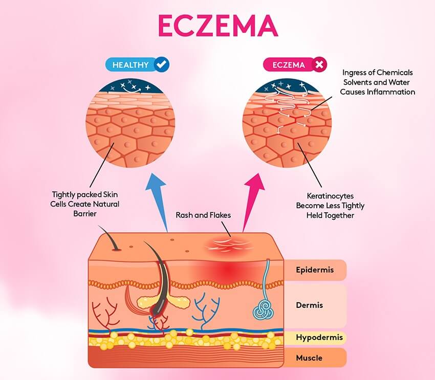 Eczema: Symptoms
