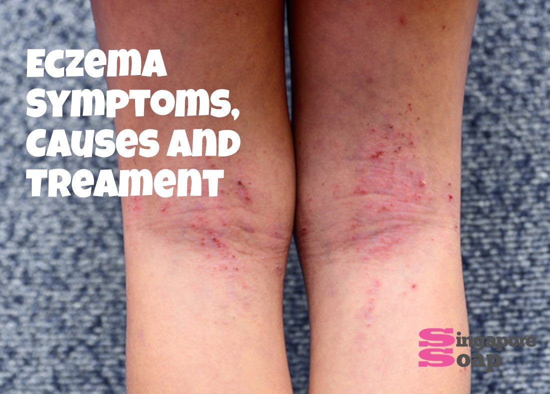 Eczema (Symptoms, Causes &  Treatment)