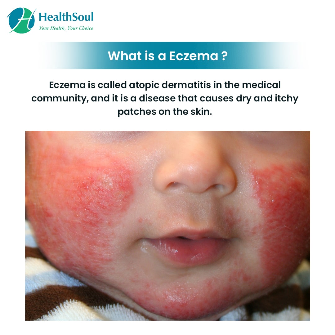 Eczema: Symptoms, Diagnosis and Treatment â Healthsoul