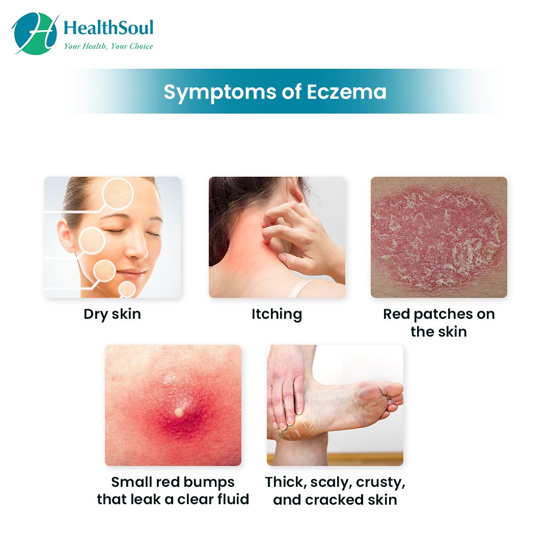 Eczema: Symptoms, Diagnosis and Treatment