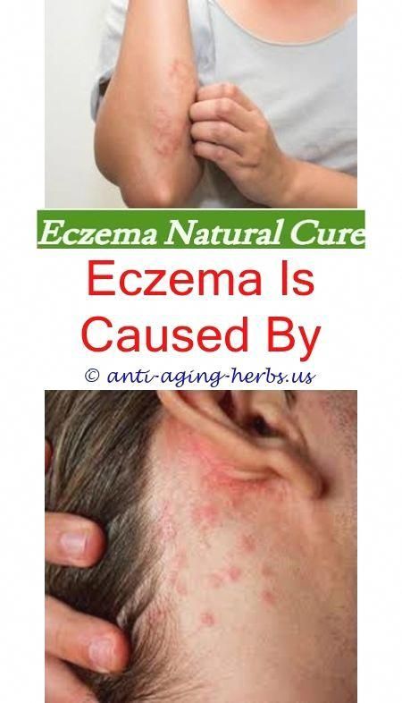 eczema symptoms in adults foods that fight eczema