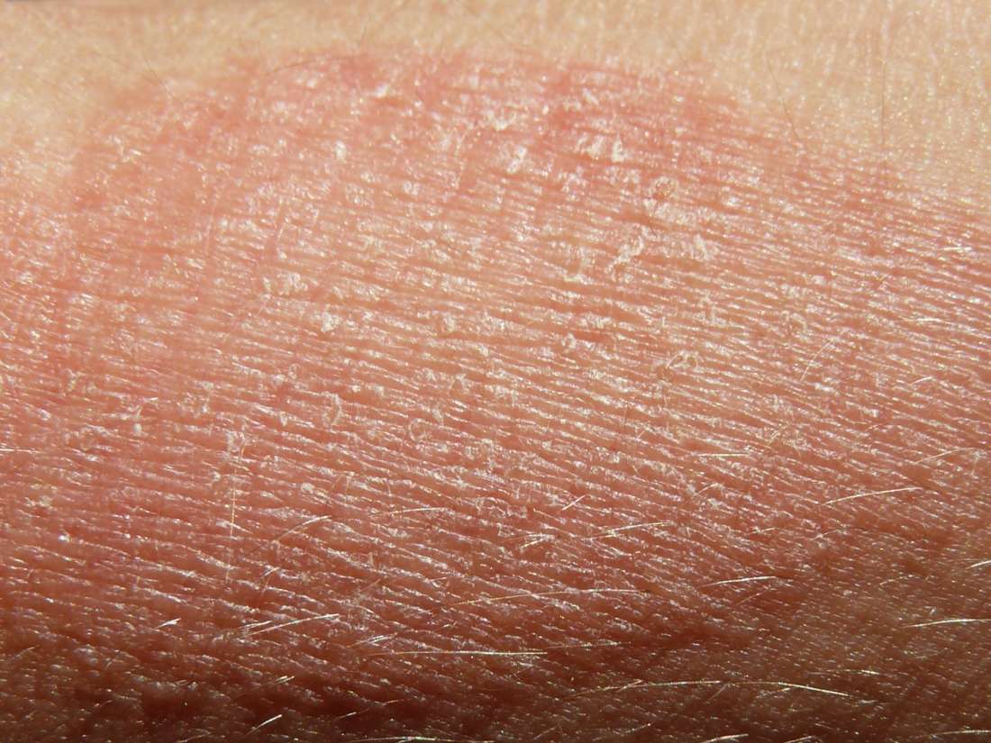 Eczema: Symptoms, treatment, and causes