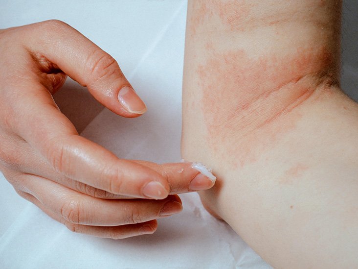 Eczema: Symptoms, treatment, causes, and types