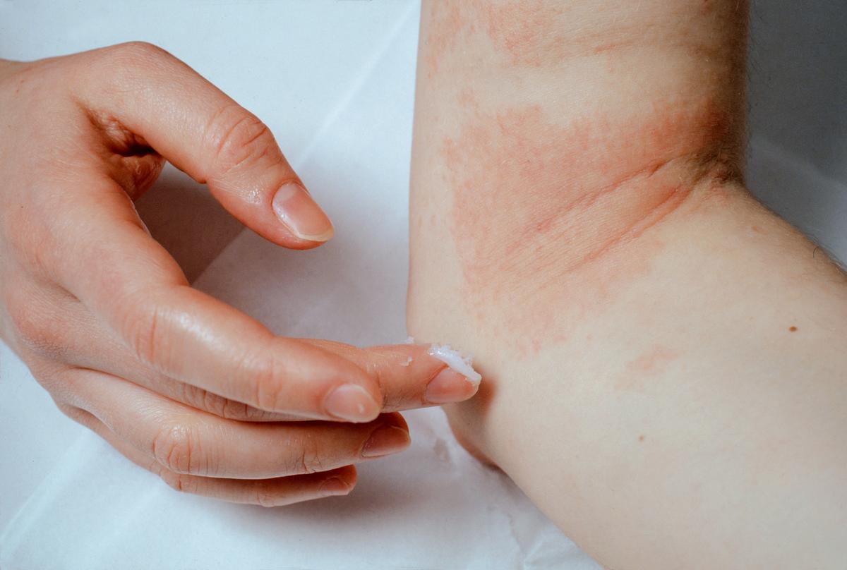 Eczema: Symptoms, Treatments and Causes â Dermatological ...