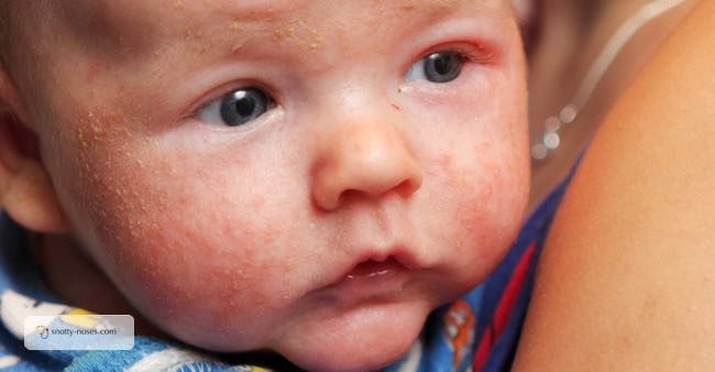 Eczema tips from eczema specialist for your infant