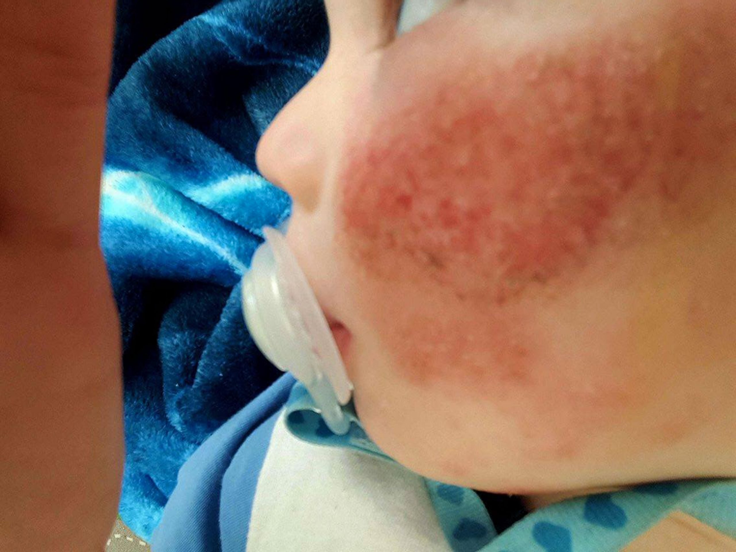 Eczema: Toddler suffers so badly it looks like he has been bashed