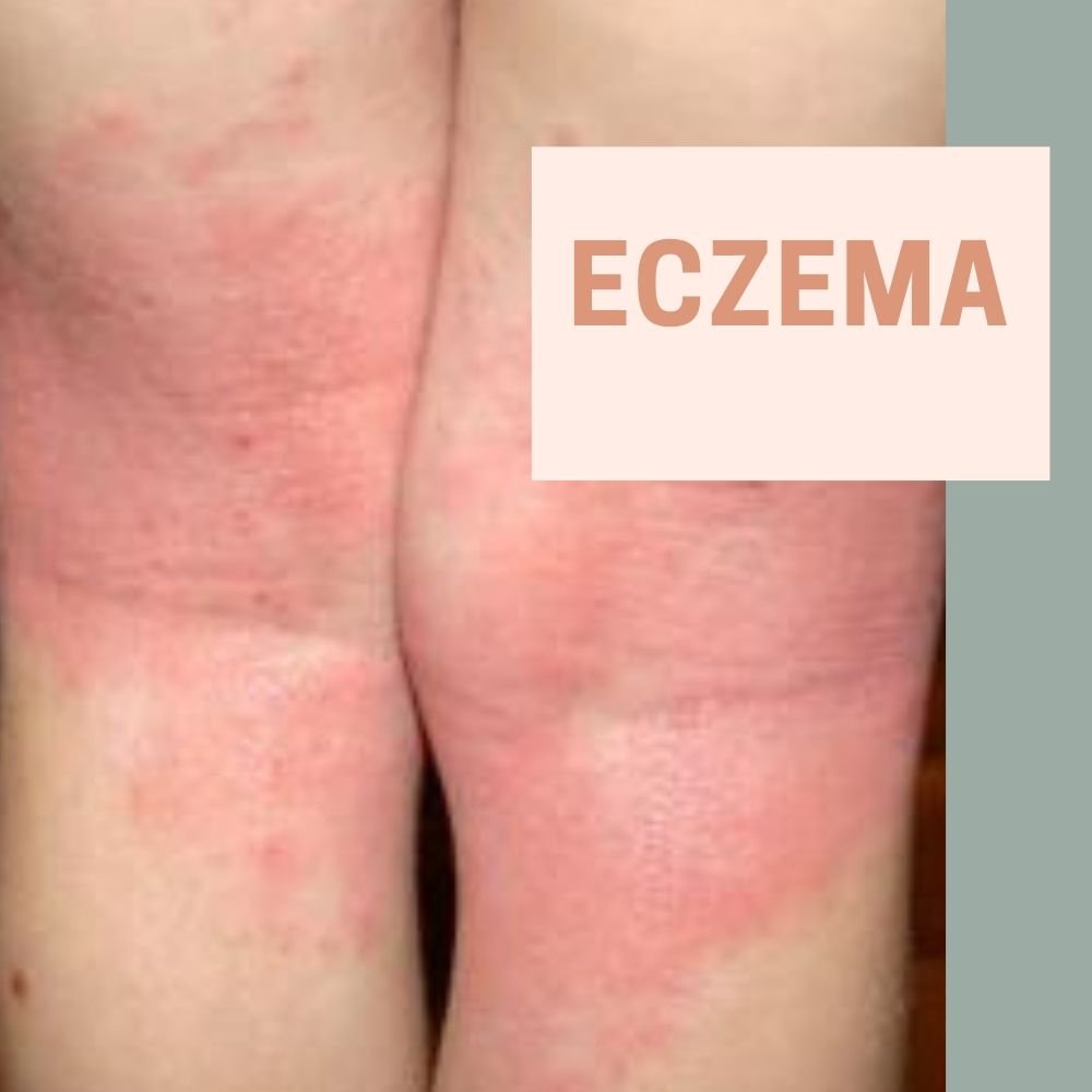 Eczema Treatment in Singapore