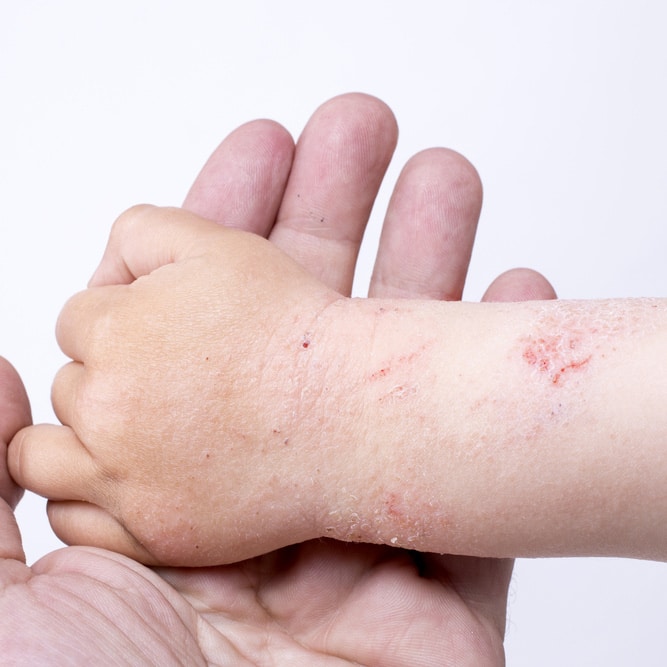 Eczema Treatment Lehi