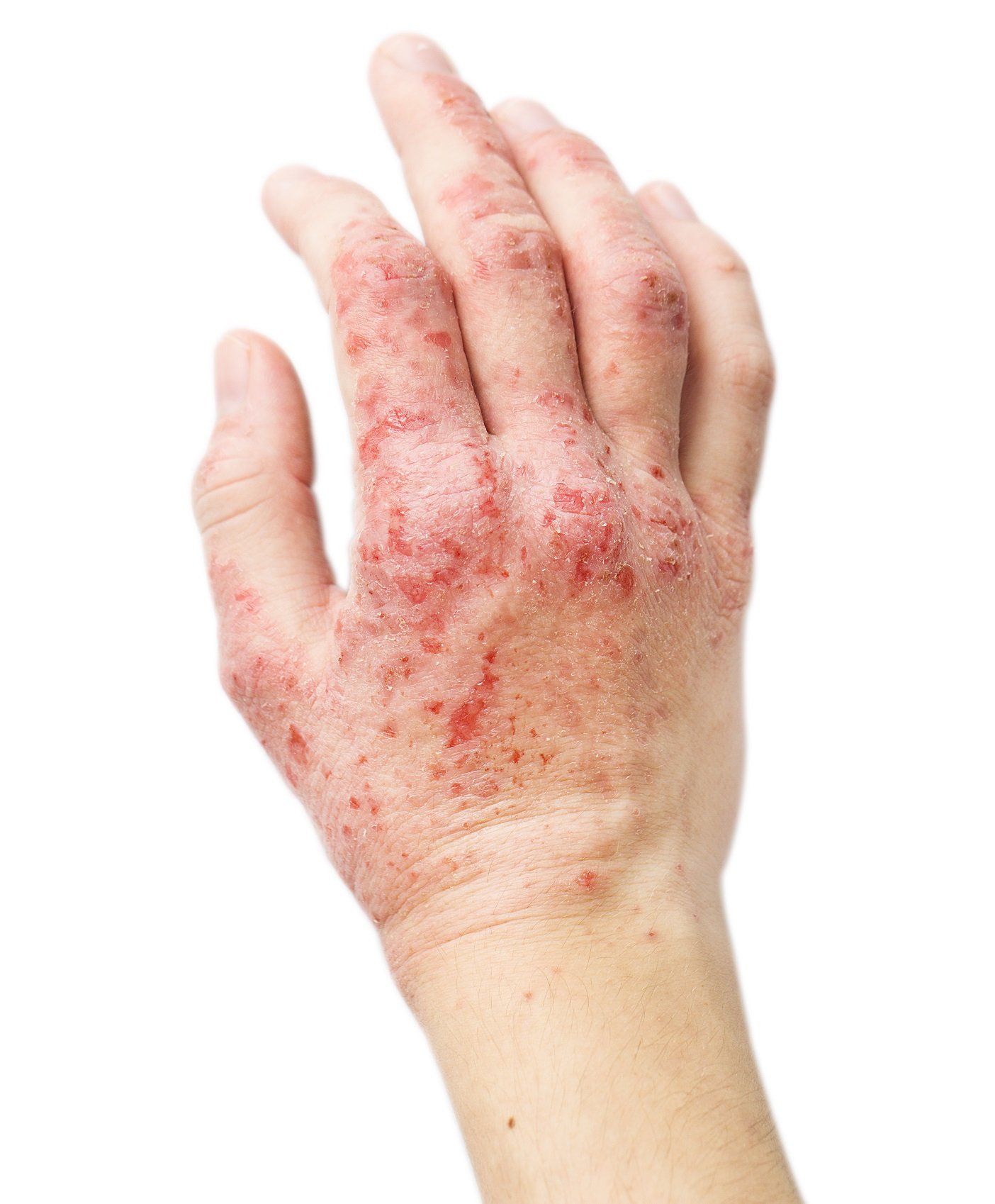 Eczema Treatment Malaysia  Leading Skin and Aesthetic ...
