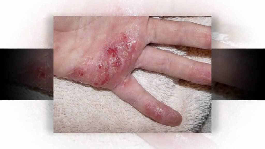 Eczema Treatment Over The Counter And Heal?