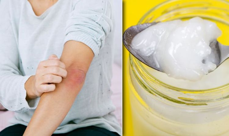 Eczema treatment: Prevent dry and itchy skin at home with coconut oil ...