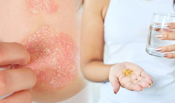 Eczema treatment: Vitamin E could help to ease symptoms and reduce rash ...
