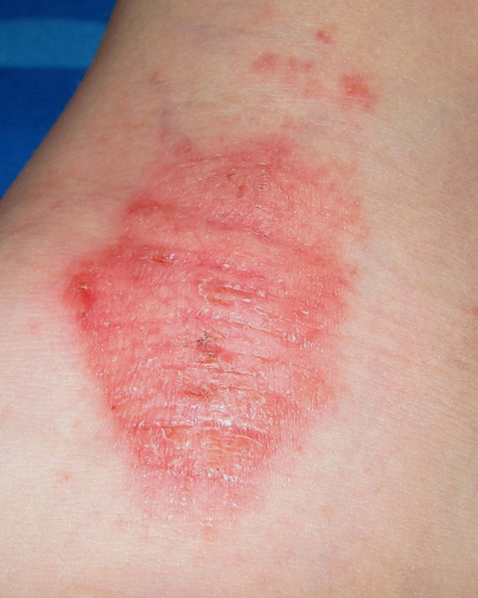 Eczema. Treatments, Help, Advice and Pictures for Mild to Extreme Cases ...