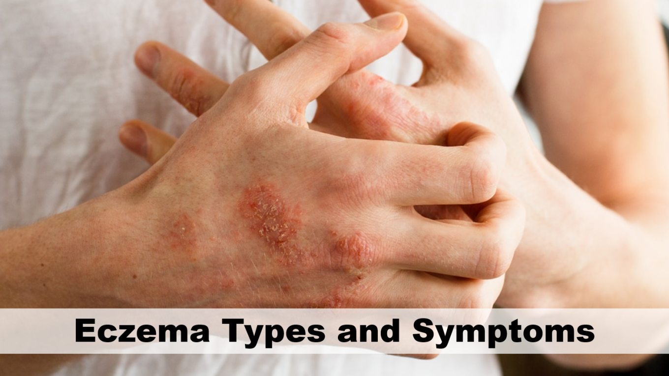 Eczema Types and Symptoms