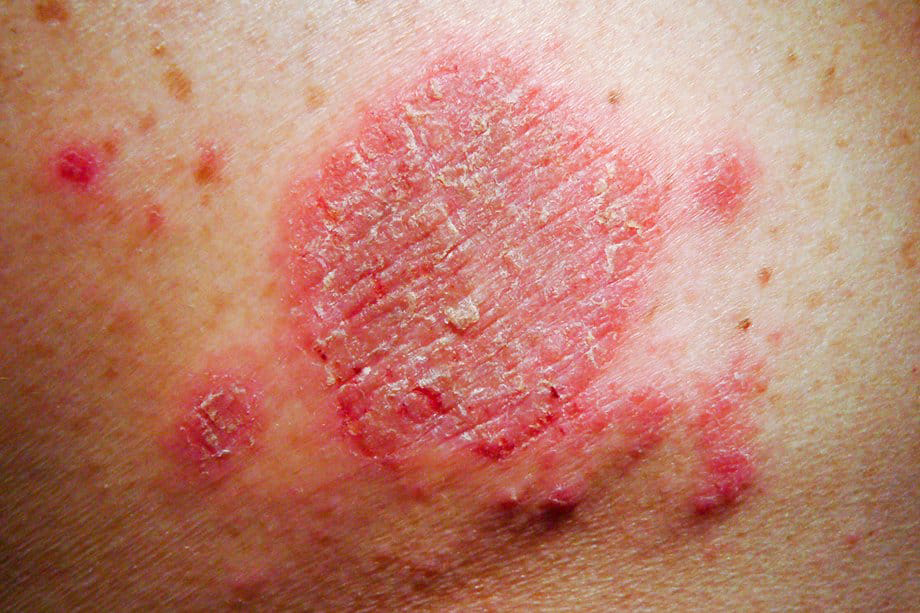Eczema: Types, Causes, Ways of Prevention