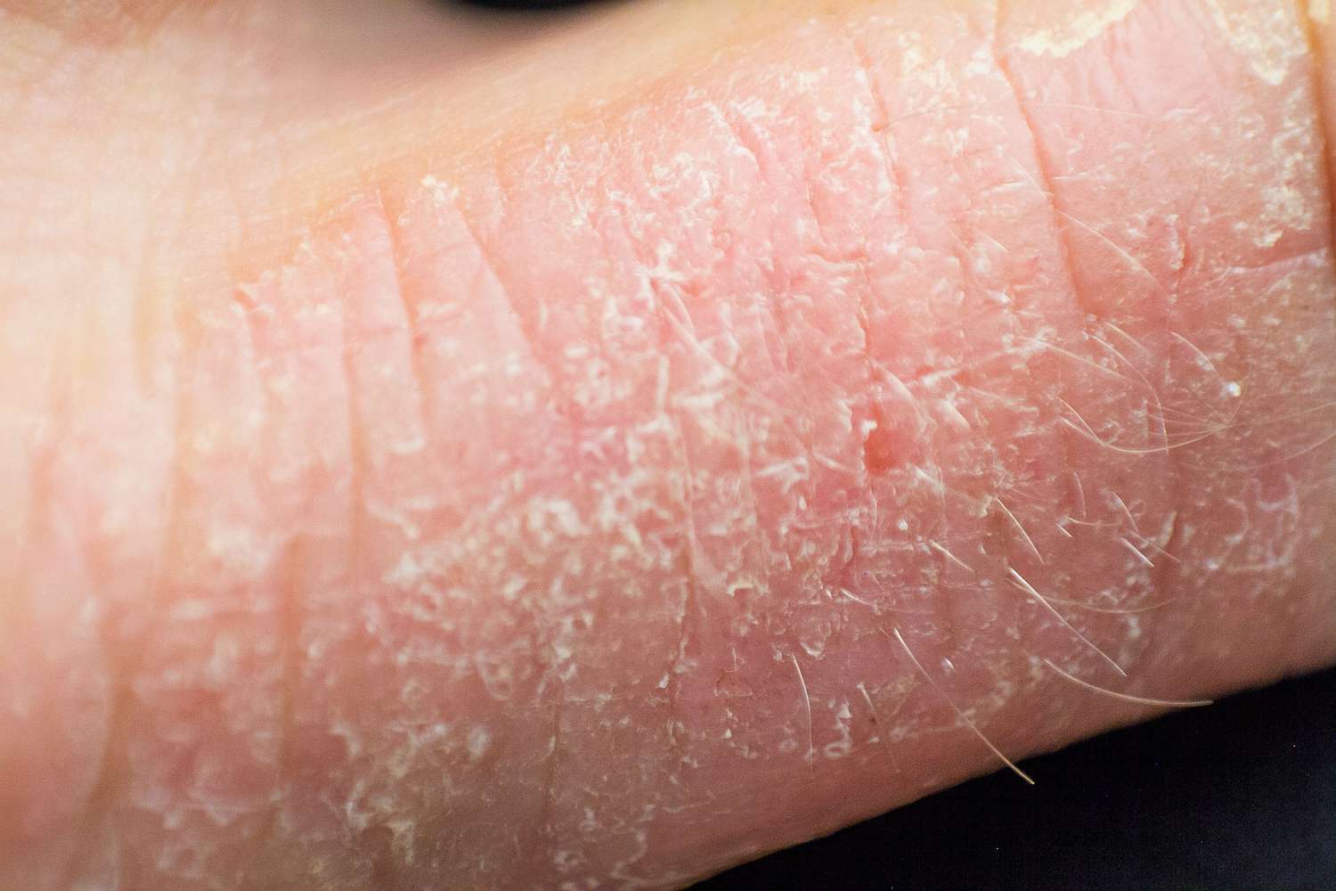 Eczema: Understanding Why It