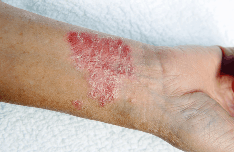Eczema vs. Bed Bug Bites: How to Tell the Difference? (W/Pics)