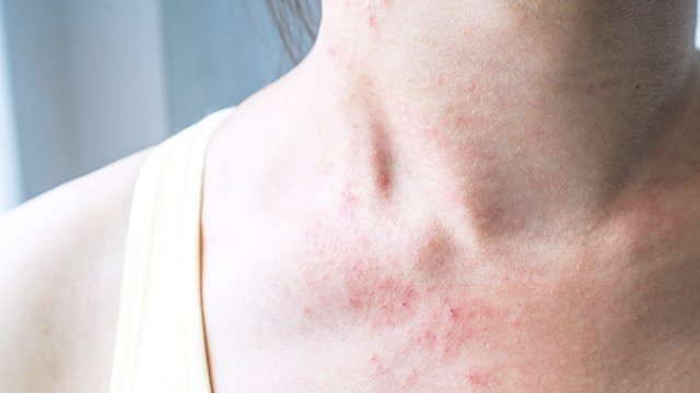 Eczema Vs. Fungal Skin Infection: Causes, Differences ...