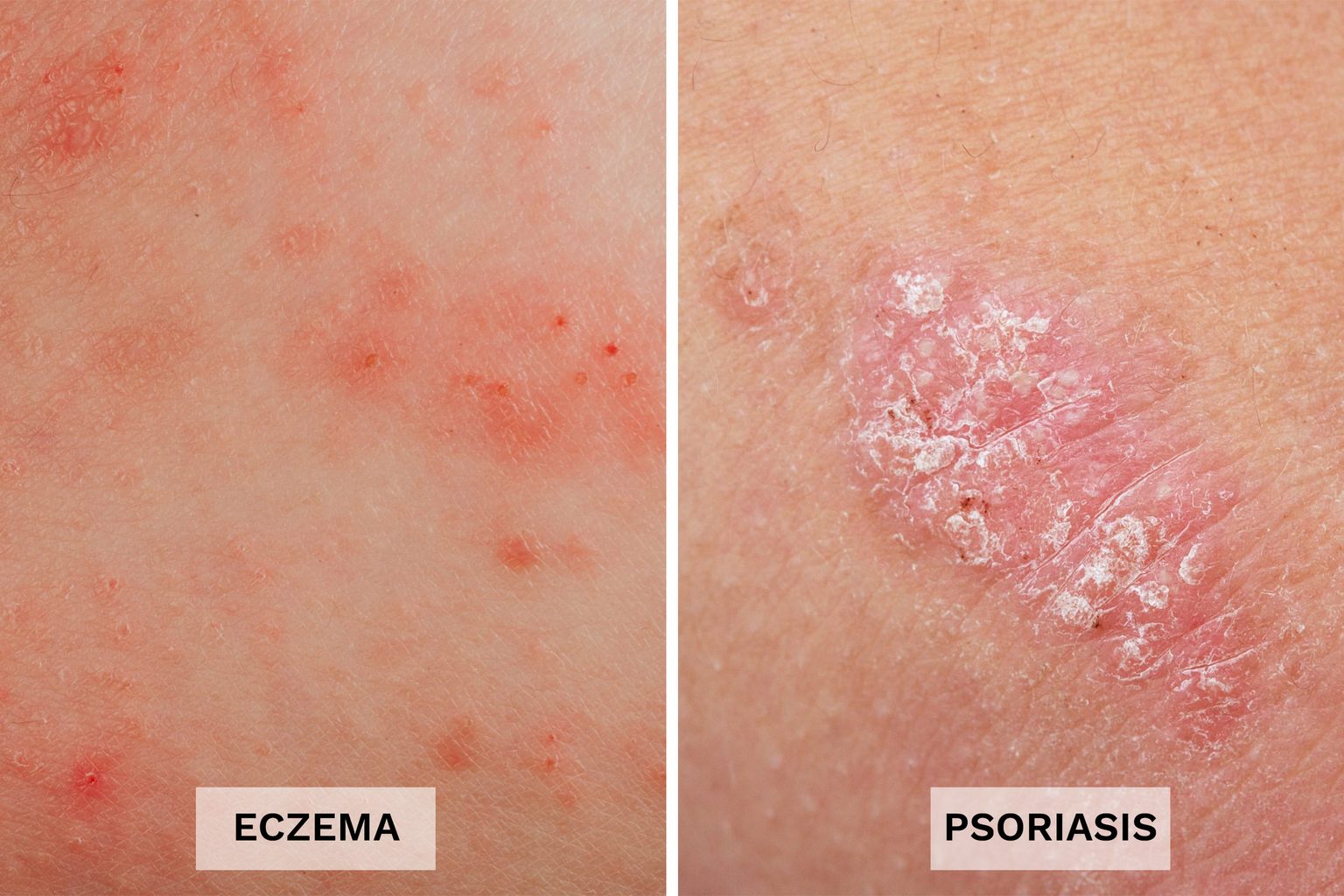Eczema vs. Psoriasis: 13 Differences You Should Know