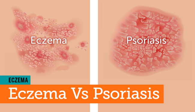 Eczema vs. Psoriasis: Are They One and the Same ...