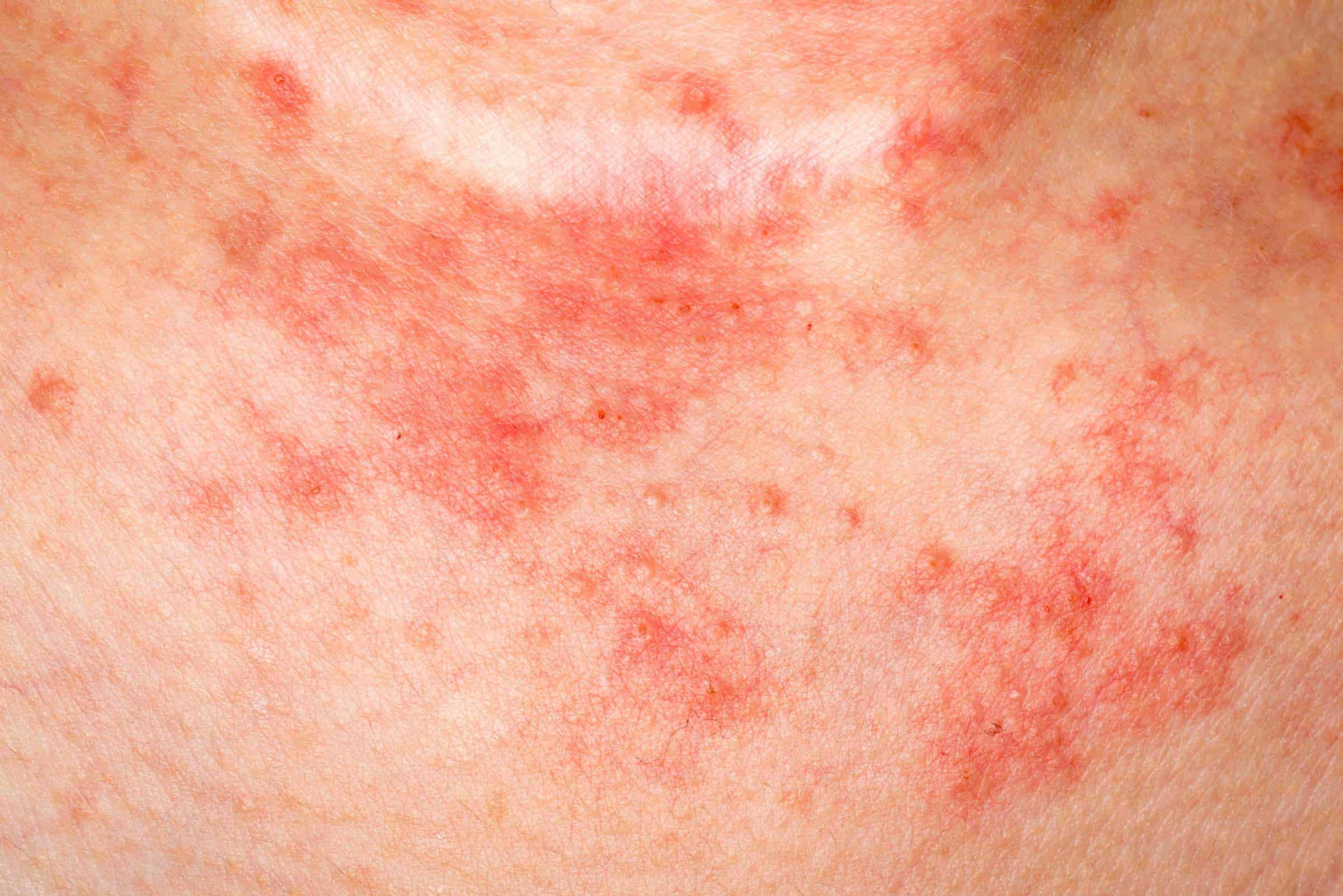 Eczema vs Psoriasis: What You Should Know