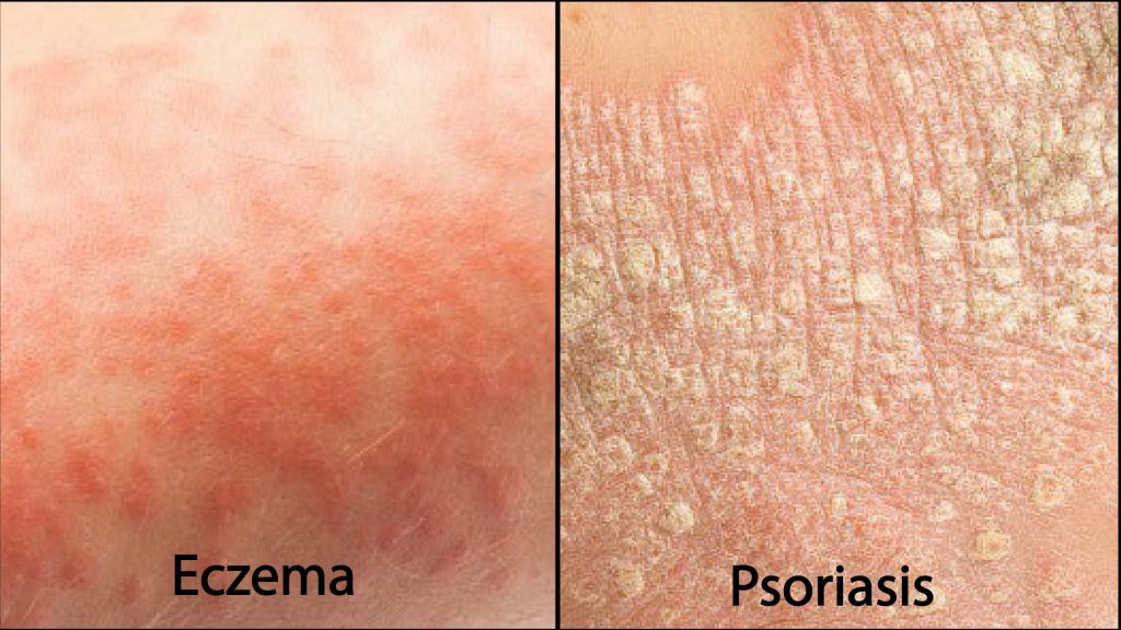 ECZEMA VS PSORIASIS  WHICH ONE DO I HAVE?  Ultra Bee ...