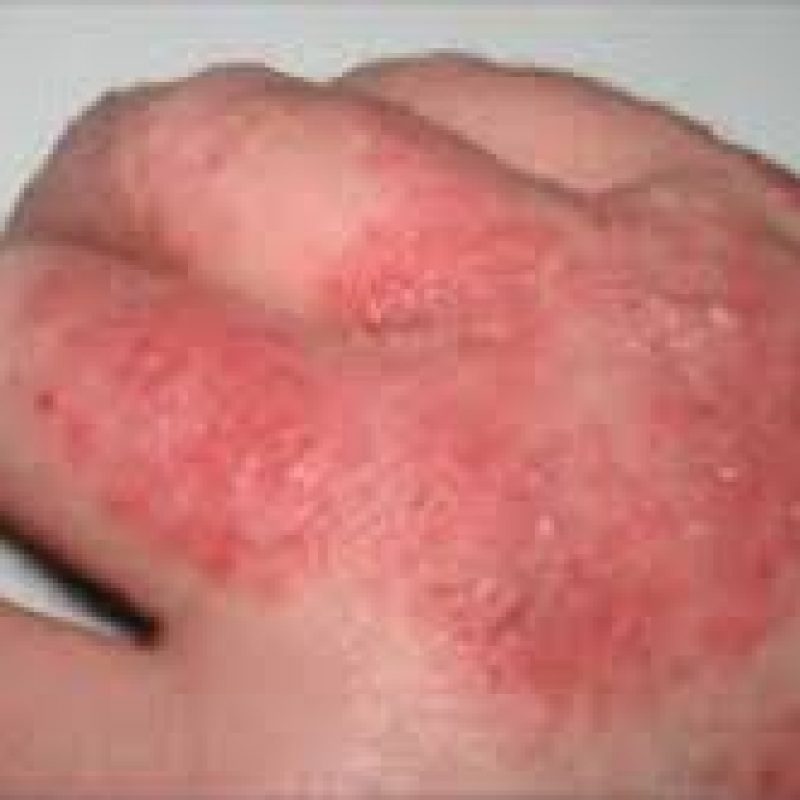 Eczema: What is eczema and can you ever get rid of it?