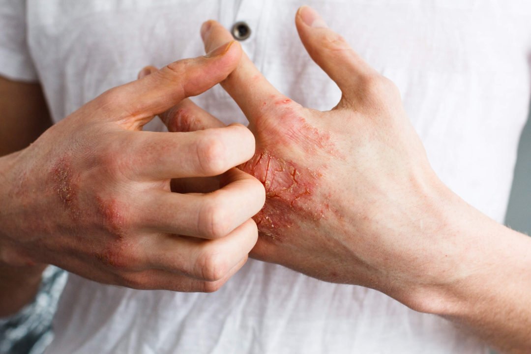 Eczema. What is it?