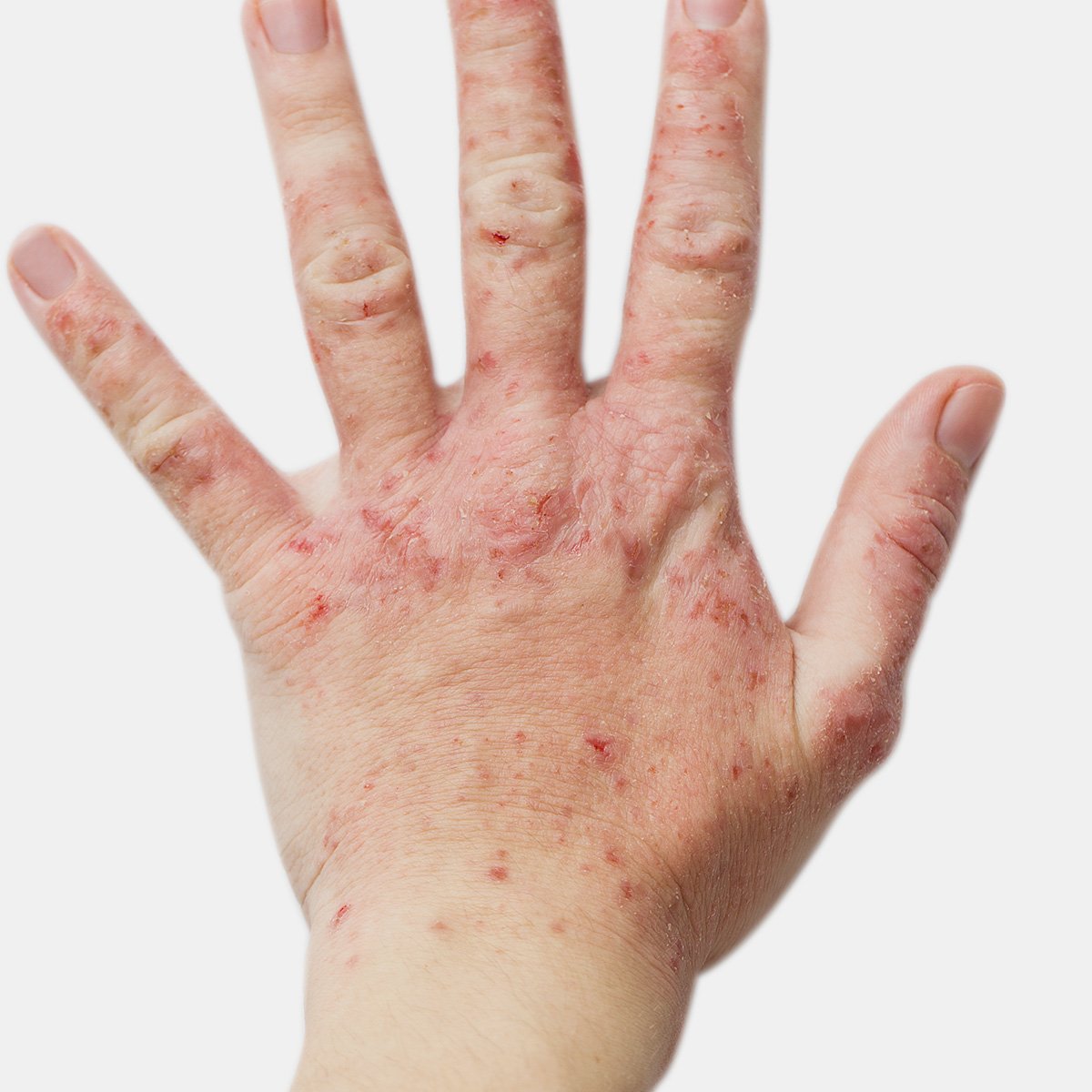 Eczemas