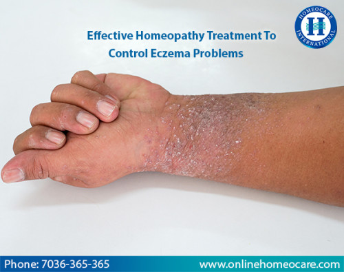 Effective Homeopathy Treatment To Control Eczema Problems