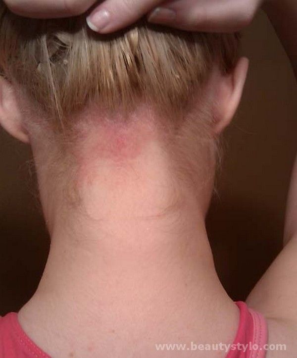 Every body have face that problem of scalp eczema in hair. It have many ...