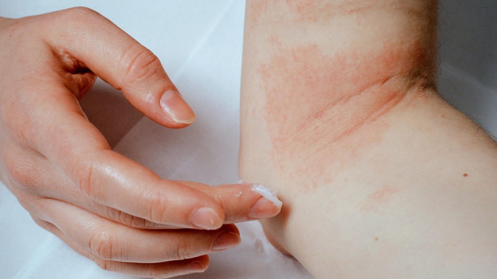 Everything You Need To Know About Eczema (Atopic Dermatitis), With ...