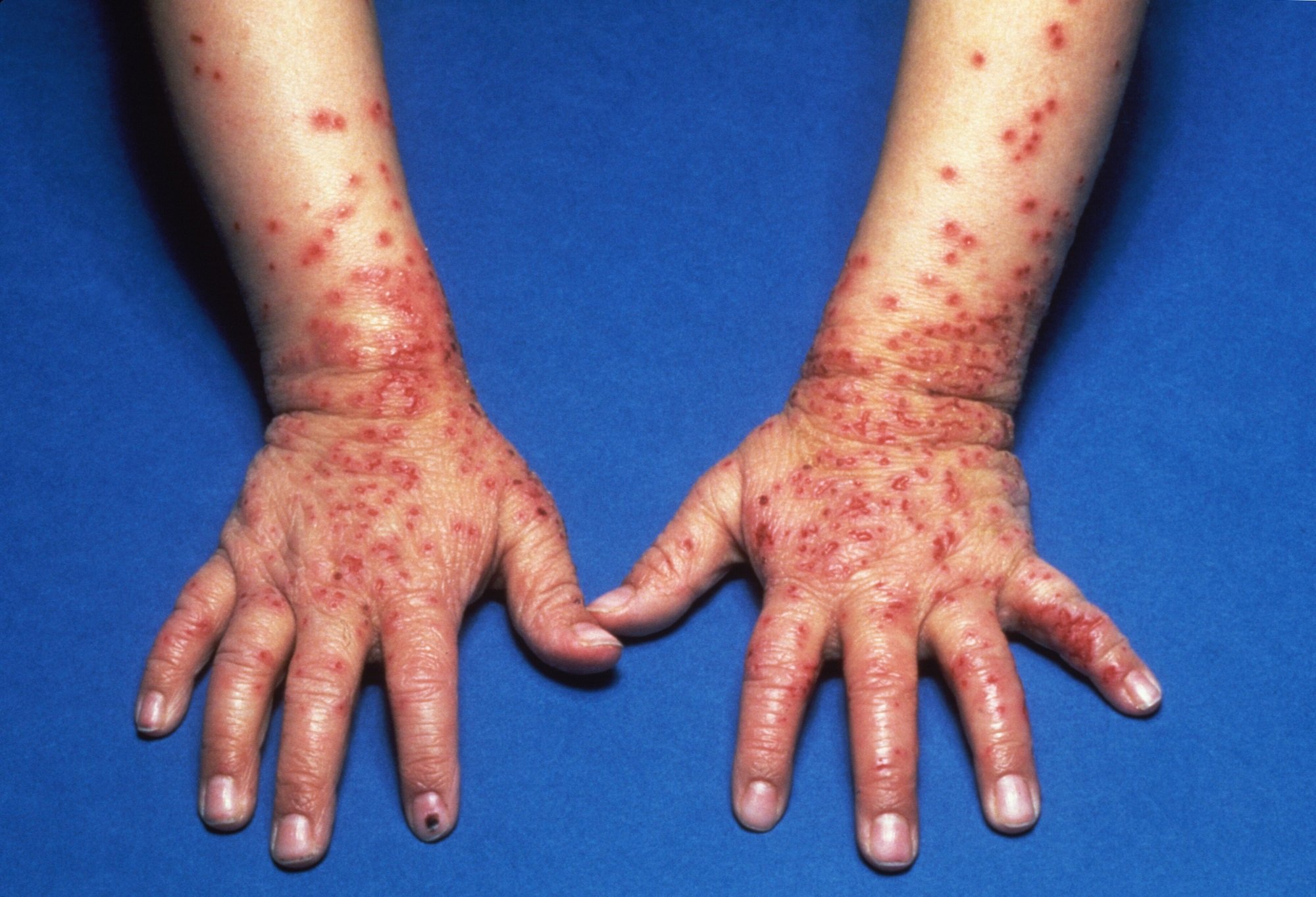 Extrinsic Atopic Dermatitis Linked to Risk for Eczema ...