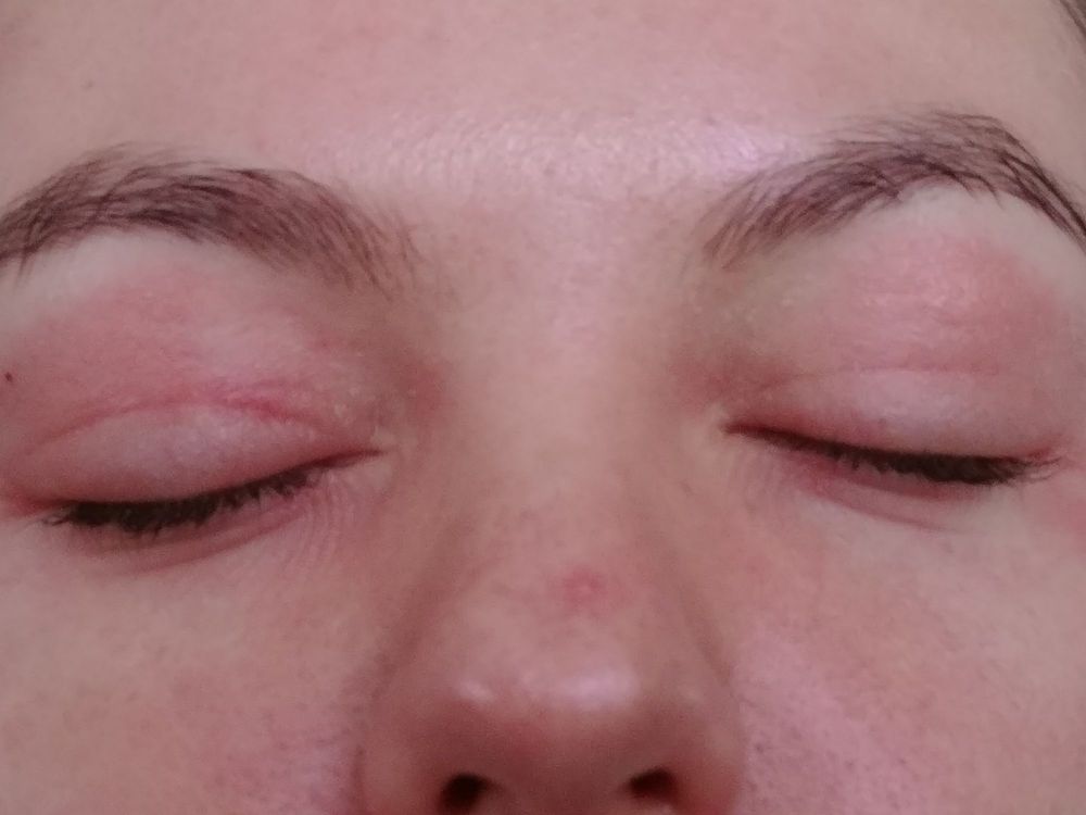 Eyelid Contact Dermatitis Pictures