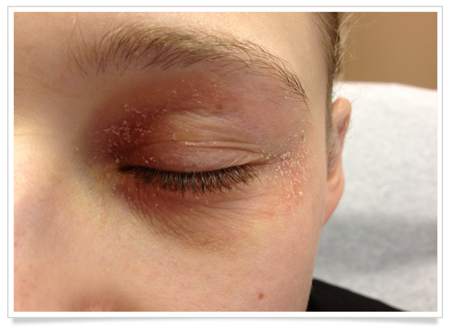 Eyelid Dermatitis