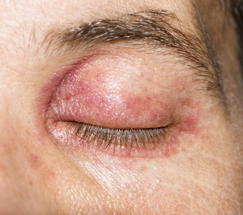 Eyelid dermatitis: Treatment, symptoms, and causes