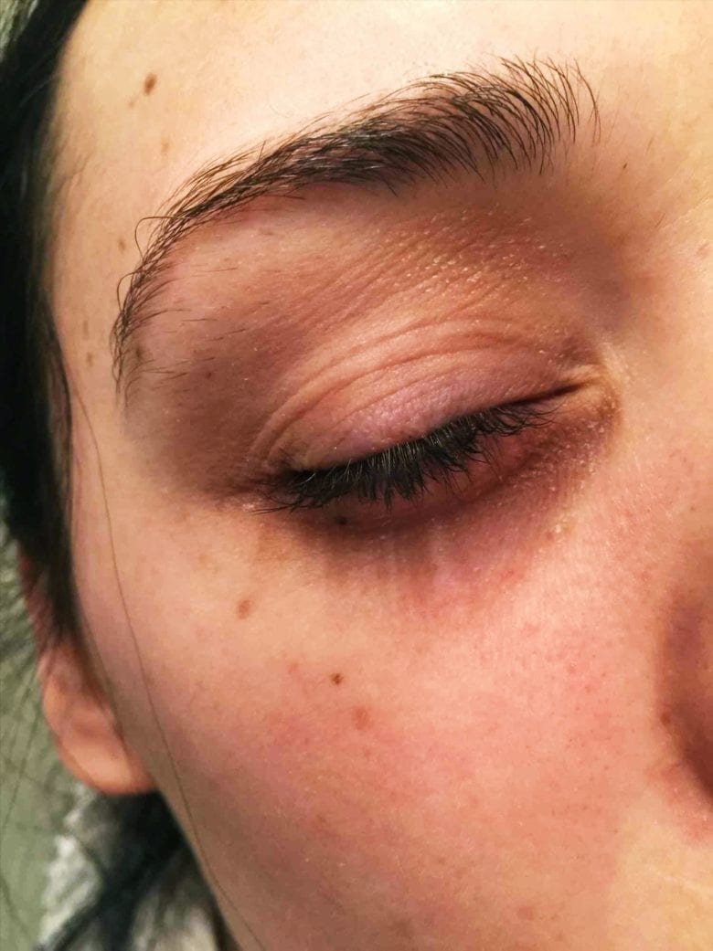 Eyelid Eczema Treatment