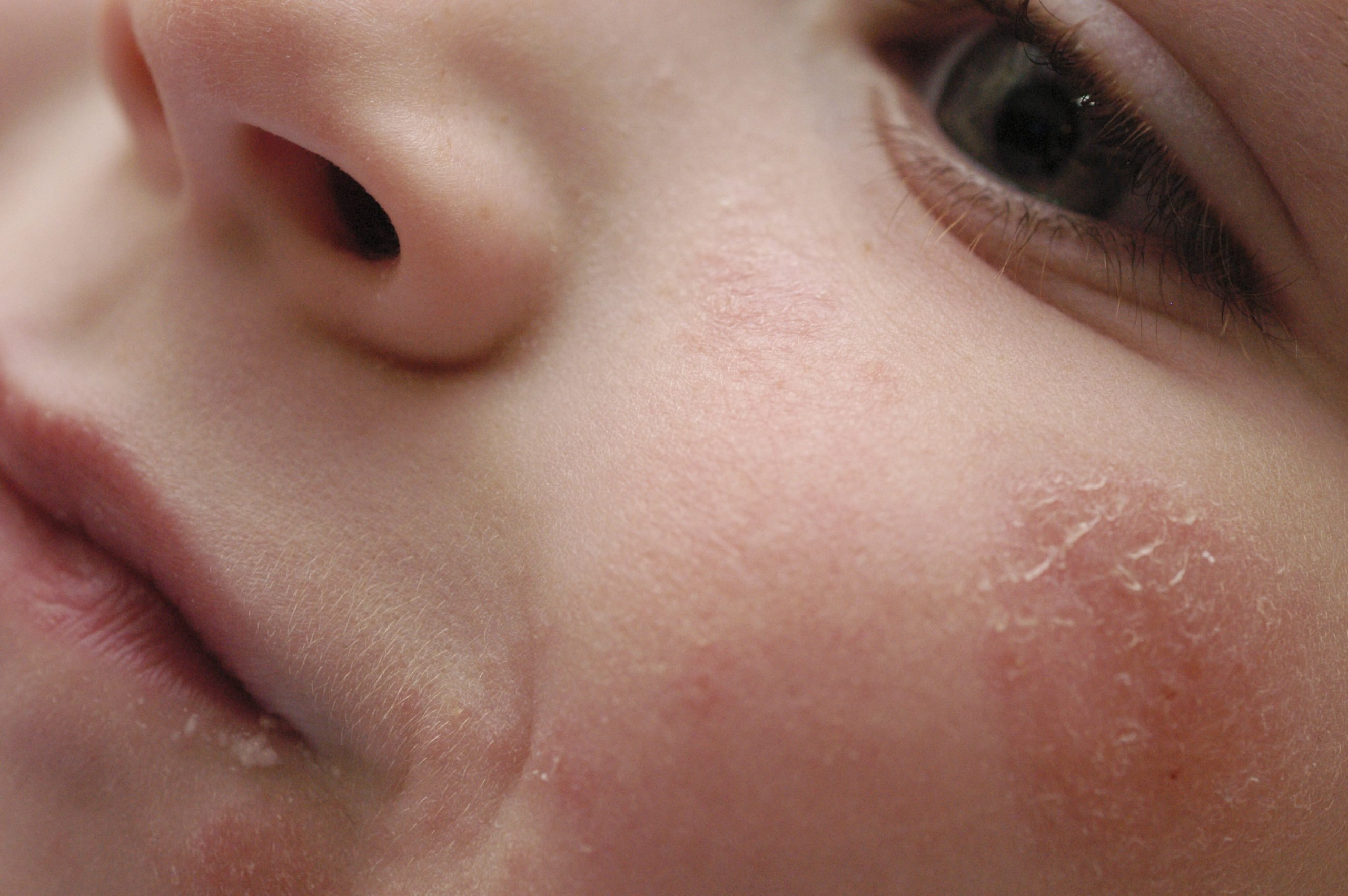 Facial Eczema Facts