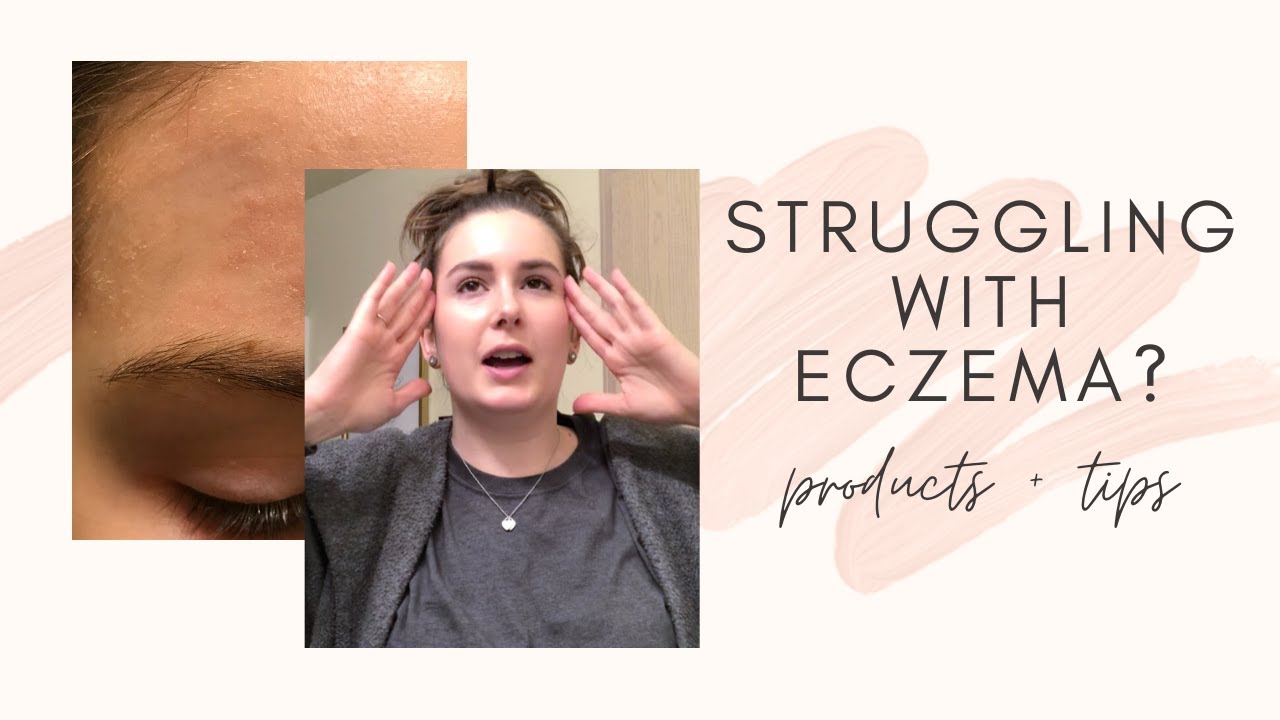 Facial Eczema? Hereâs how to fix it quickly