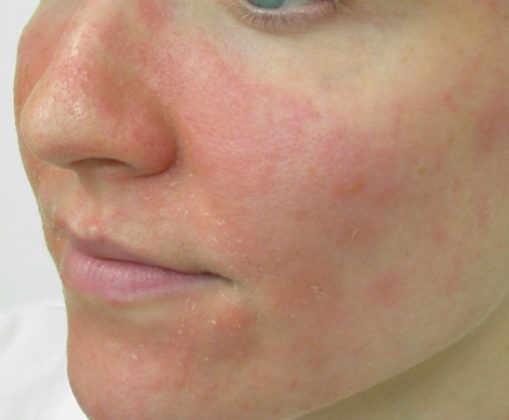 Facial Eczema Treatment