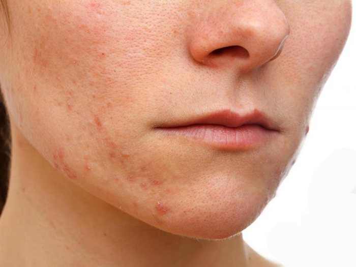 Facial Eczema