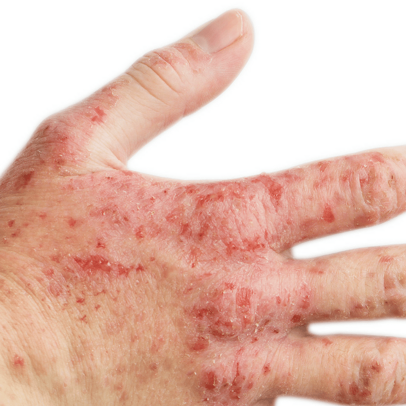 Feeling itchy this winter? You may have eczema, a condition that causes ...
