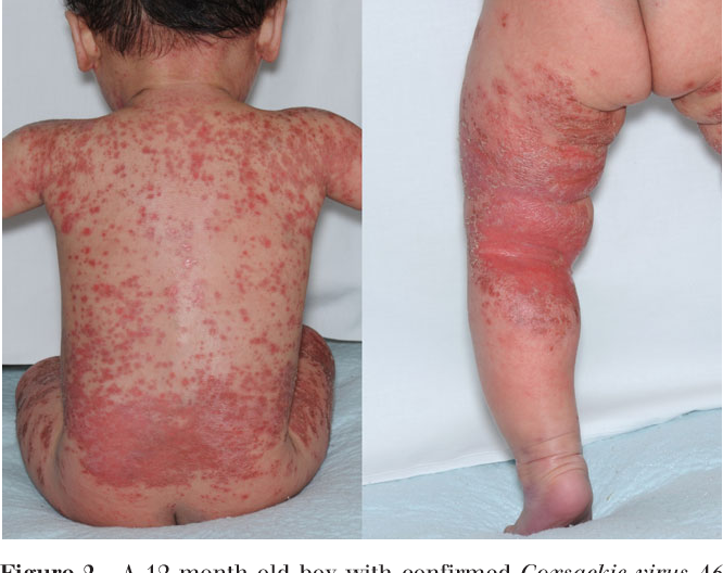 Figure 1 from Eczema exacerbation caused by Coxsackie virus A6 ...