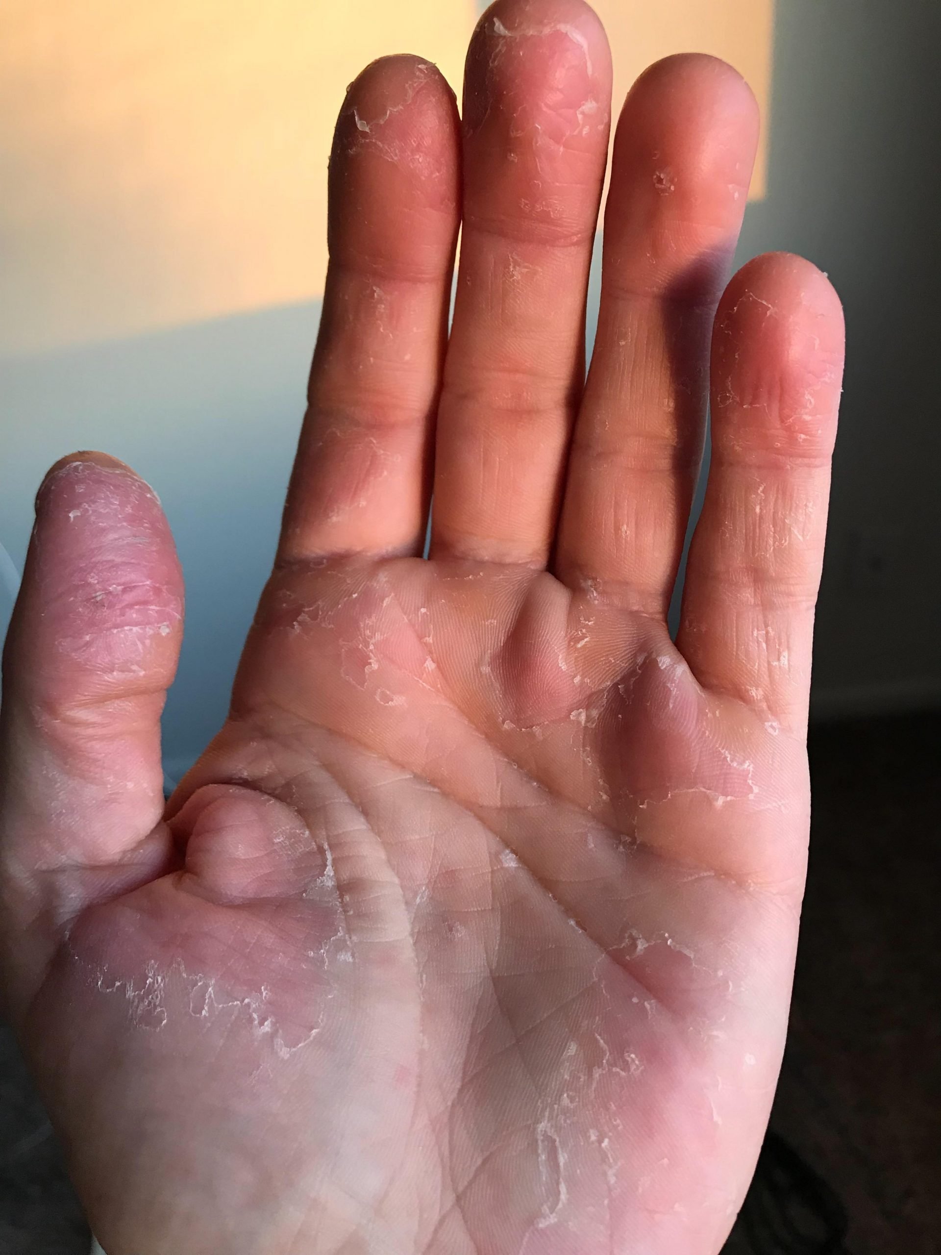 First flare up and just diagnosed with eczema on hands. Given steroid ...